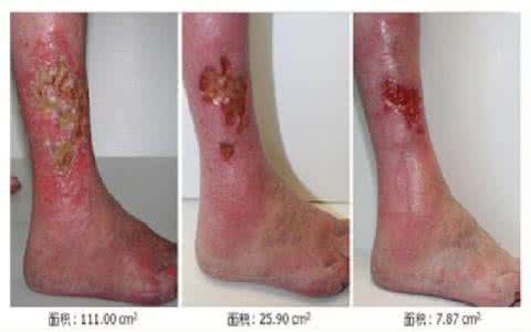 臁疮腿的治疗方法 腿上生疮怎么办？
