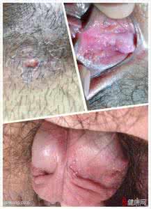 假性尖锐湿疣的症状是什么呢 有什么治疗方法