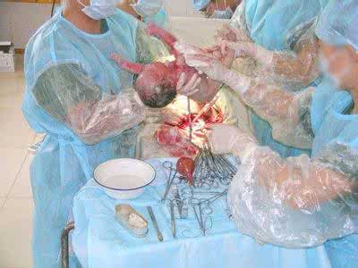 剖腹产择吉日 择吉日的剖腹产
