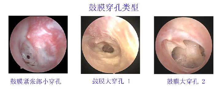 中耳炎耳膜穿孔治疗 中耳炎耳膜穿孔治疗 耳膜穿孔 出现这一情况应该如何治疗