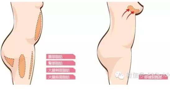 自体脂肪丰乳 自体脂肪丰乳对身体有什么害处吗