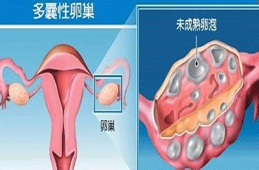 人工授精多囊卵巢 人工授精与多囊卵巢 “人工卵巢技术”