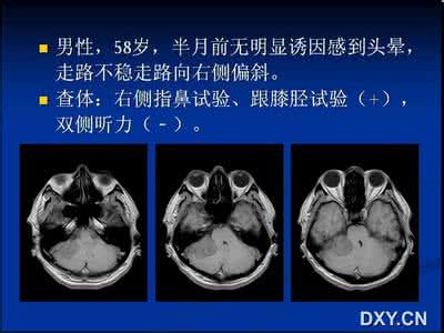 纵隔恶性肿瘤存活时间 【读片时间】第0372期:纵隔恶性孤立性纤维瘤