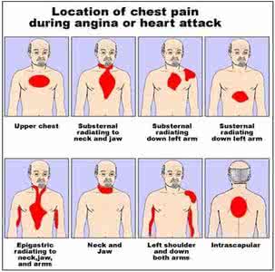 心绞痛的治疗方法 心绞痛的治疗方法 心绞痛的锻炼方法有哪些