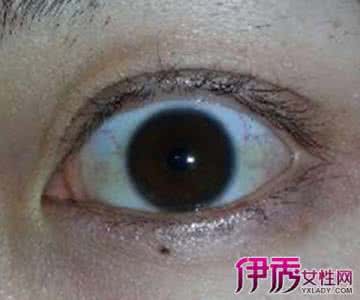 眼白有点黄是怎么回事 眼睛眼白发黄是怎么回事