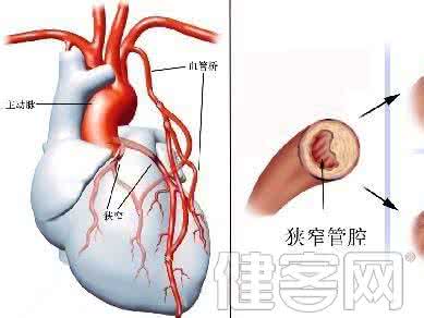 心脏手术的急性并发症 心脏手术的急性并发症 心脏猝死会产生哪些并发症