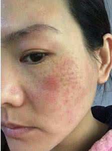 阿司匹林能去斑点吗 斑点怎么淡化 一个阿司匹林60秒淡化3年斑点,嫩如婴儿般光滑