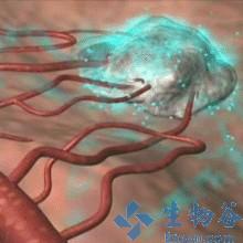 血管畸形治疗费用 肿瘤治疗：抑制血管生成或促进血管正常化