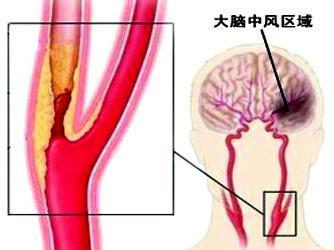 颈动脉斑块能消除吗 颈动脉斑块怎么治疗