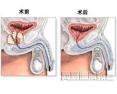 预防前列腺癌的食物 怎样预防前列腺癌 预防前列腺癌常吃三类食物
