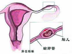 宫外孕概念 宫外孕常识:几个重要概念