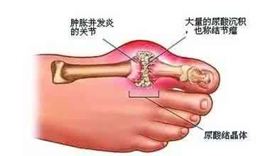 尿酸高身体有哪些症状 尿酸高是怎么回事 要警惕身体内尿酸高