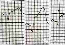 心电图负荷判断不可以 一句话判断心电图