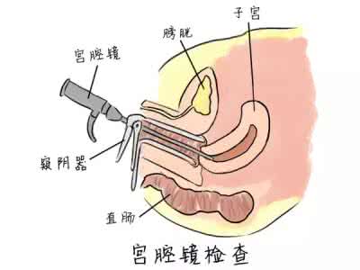 快来月经时同房出血 快来月经时同房出血, 阴道出血是怎么一回事