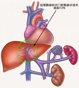 脾功能亢进的原因 脾功能亢进 这些原因会造成脾功能亢进