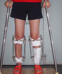宝宝o型腿怎么矫正 o型腿怎么矫正 宝宝腿不直就是O型腿需矫正？别让忽悠了你！