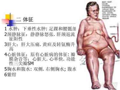 心衰的临床表现及治疗 心衰是怎么回事 心衰的临床表现与治疗