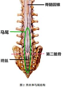 脊髓栓系综合征 脊髓栓系综合征病因的研究进展