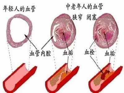 清洗血管 【健康常识】一张图告诉你:清洗血管的食疗法