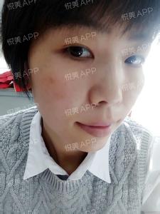 汗斑的最佳治疗方法 汗斑最佳治疗方法让“斑主任”下班