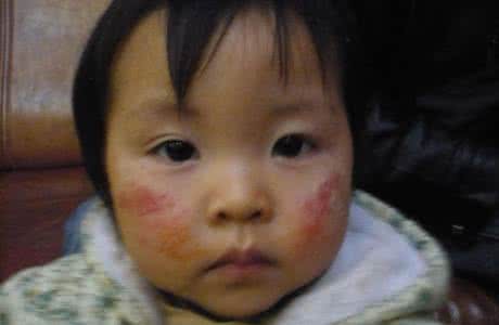 婴儿湿疹 益肤清 激素 渗出性湿疹怎么办 渗出性婴儿湿疹   鹊肤讲解