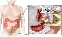 肛门脱肛能自愈吗 祖传秘方：小儿肛门脱出百治百愈脱肛外治方