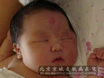 肝里的血管瘤严重吗 血管瘤严重吗 血管瘤的危害有哪些