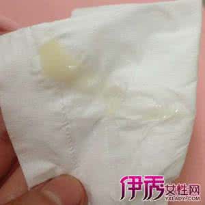 白带多怎么治疗方法 有白带怎么治疗方法 白带多的治疗方法