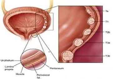 膀胱癌的病因 走近膀胱癌 膀胱癌的病因与症状