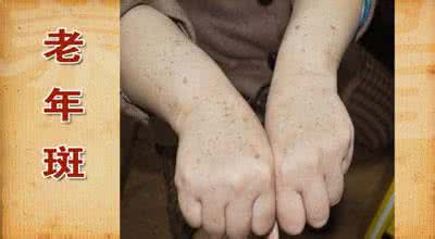 手上为什么会长老年斑 30多岁手上长斑怎么办 为何会长老年斑
