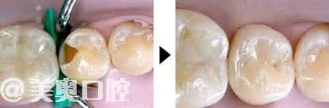 儿童补牙洞过程图解 儿童补牙洞过程图解 儿童补牙洞要麻醉吗?