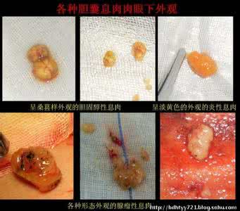 胆囊炎胆息肉治疗方法 结石胆囊炎胆息肉肝囊肿肾囊肿尿道炎的中药方
