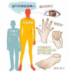 马凡氏综合症的症状 马凡氏综合症 马凡氏综合症的临床表现