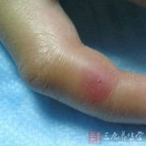 丹毒怎么彻底清除 丹毒传染吗