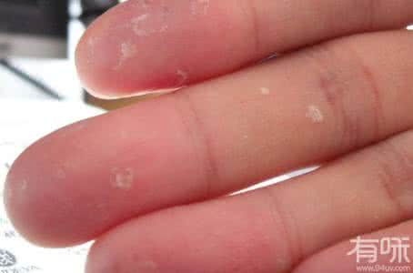 缺锌会导致什么 缺锌会导致手脚脱皮吗 手脚脱皮是怎么回事 这些因素导致手脚脱皮