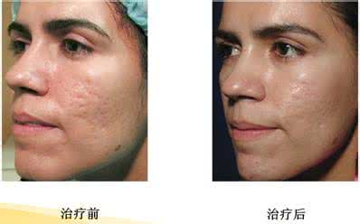 去除痤疮疤痕 去痤疮疤痕 去除痤疮疤痕
