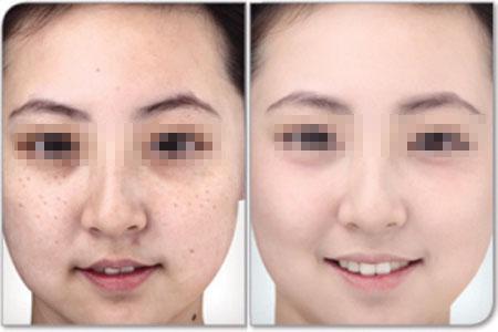 美白祛斑的方法 6个美白祛斑方法 当前最热门的6大祛斑方法