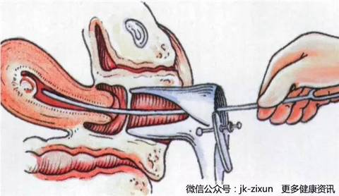 蝼蚁 不要让“蝼蚁”毁了性生活