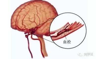 脑溢血昏迷存活率 脑血栓、脑溢血发生的前兆