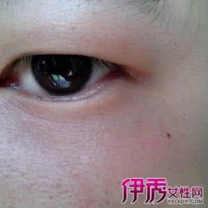 下眼睑一直跳动 眼睑跳动 一穴搞定