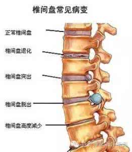 腰突症如何治疗 如何准确判断腰突症