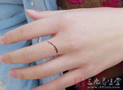 怎样让疤痕淡化 淡化疤痕 四种方法让疤痕去无踪