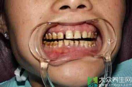 男性生殖器发育不全 幼儿牙釉质发育不全怎么回事呢？