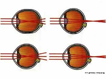 屈光不正有什么症状 屈光不正 屈光不正有哪些症状
