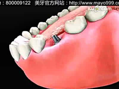 即刻种植牙 即刻种植牙 好感餐桌 即刻实现