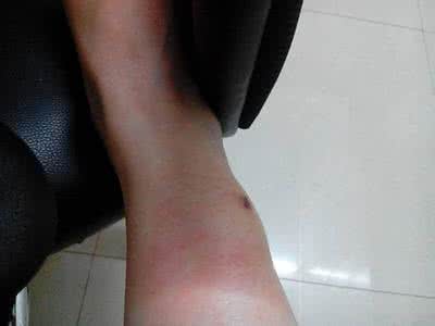 女子大腿针灸视频 针灸腿肿是怎么回事啊？