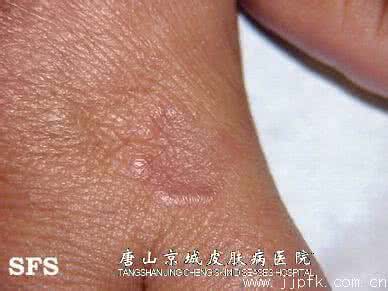 环状肉芽肿 环状肉芽肿 环状肉芽肿应该如何预防