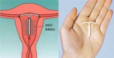 紧急避孕有哪些方法 女性紧急避孕有哪些方法有哪些工具