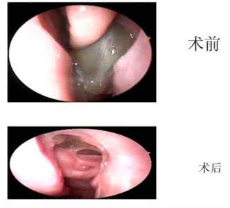 鼻窦炎的最好治疗方法 鼻窦炎的最好治疗方法 得了鼻窦炎怎么办？鼻窦炎的最好治疗方法