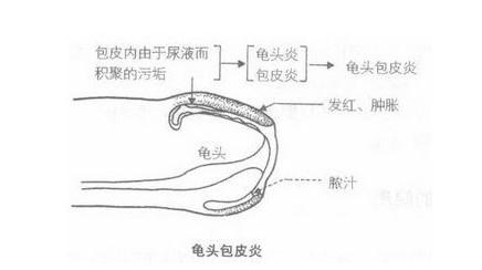 淋病性龟头包皮炎 淋病会引起龟头水肿么？